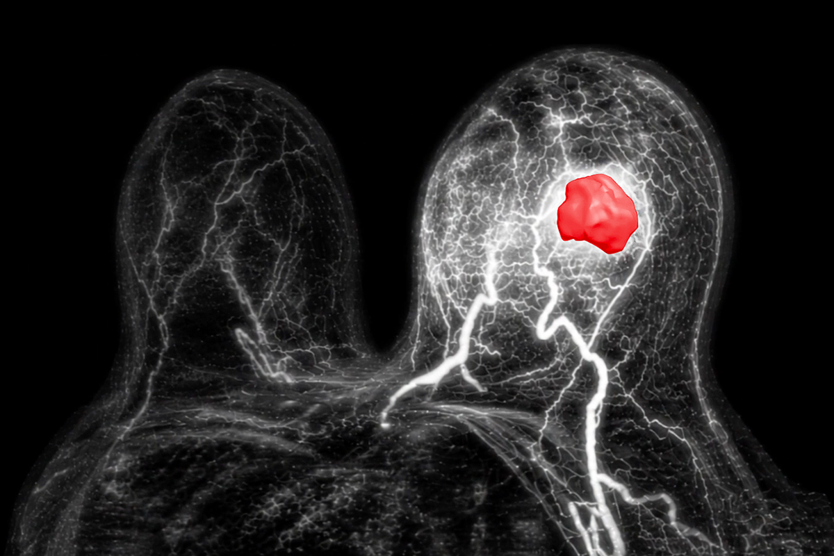 La española Quibim crea la primera IA para detectar el cáncer de mama por resonancia